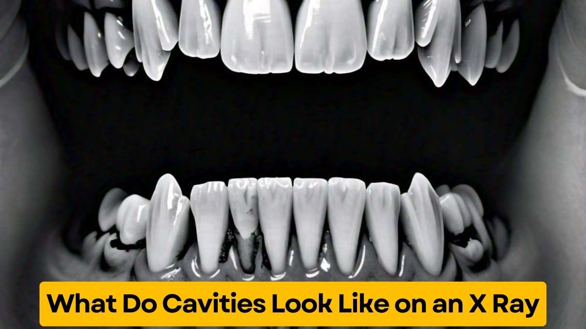 What Do Cavities Look Like on an X Ray SeekForUs